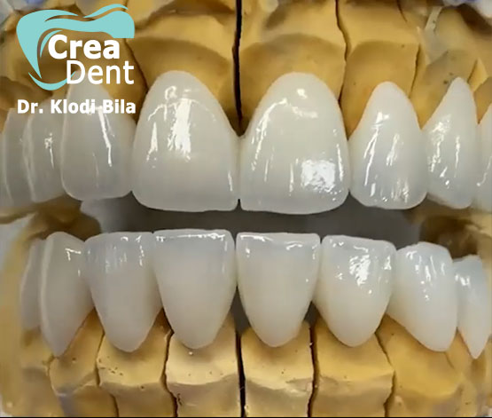 Corone in zirconio