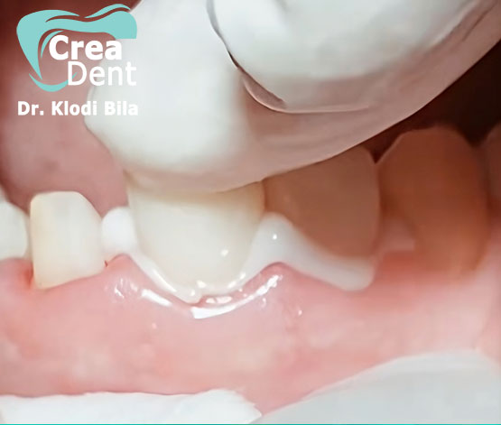 Corona su dente devitalizzato