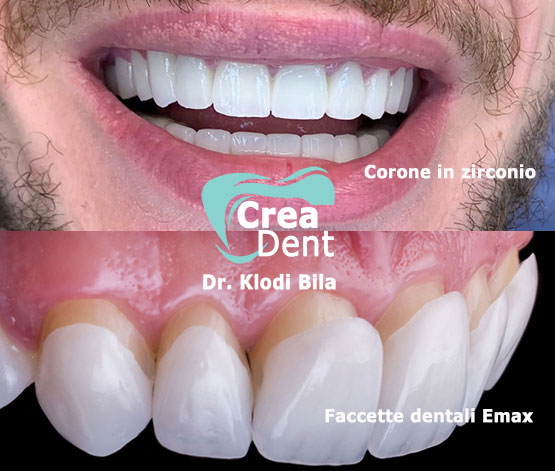 Estetica dentale in zirconio