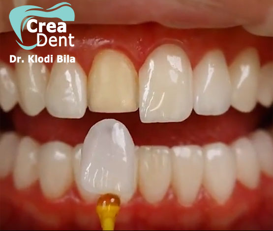 Faccette dentali