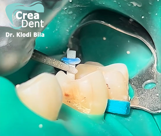 Ricostruzione del dente